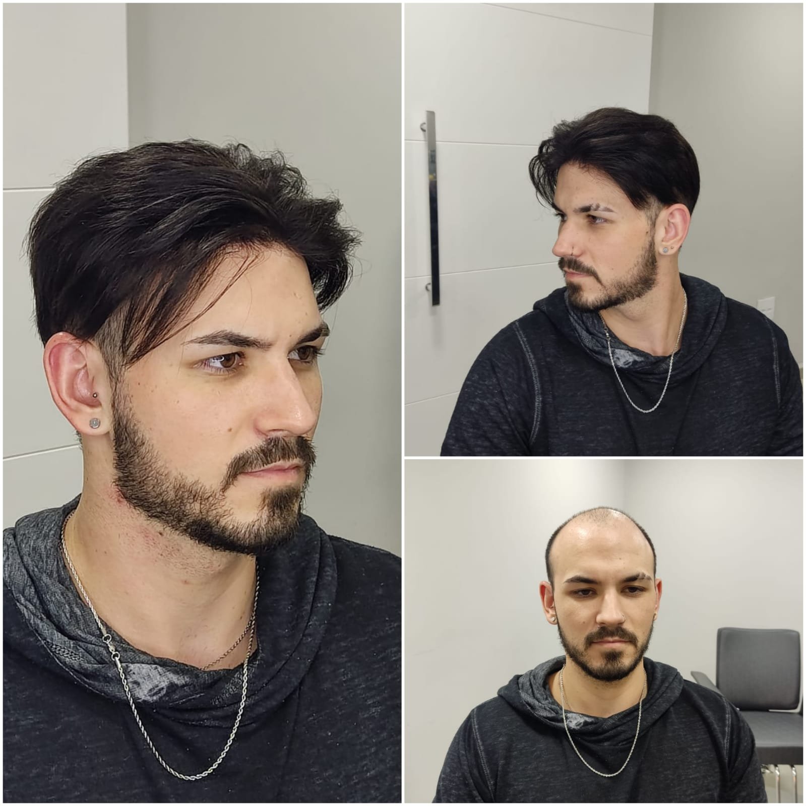 Prótese capilar em Campinas, 100% natural — Capilary Clinic