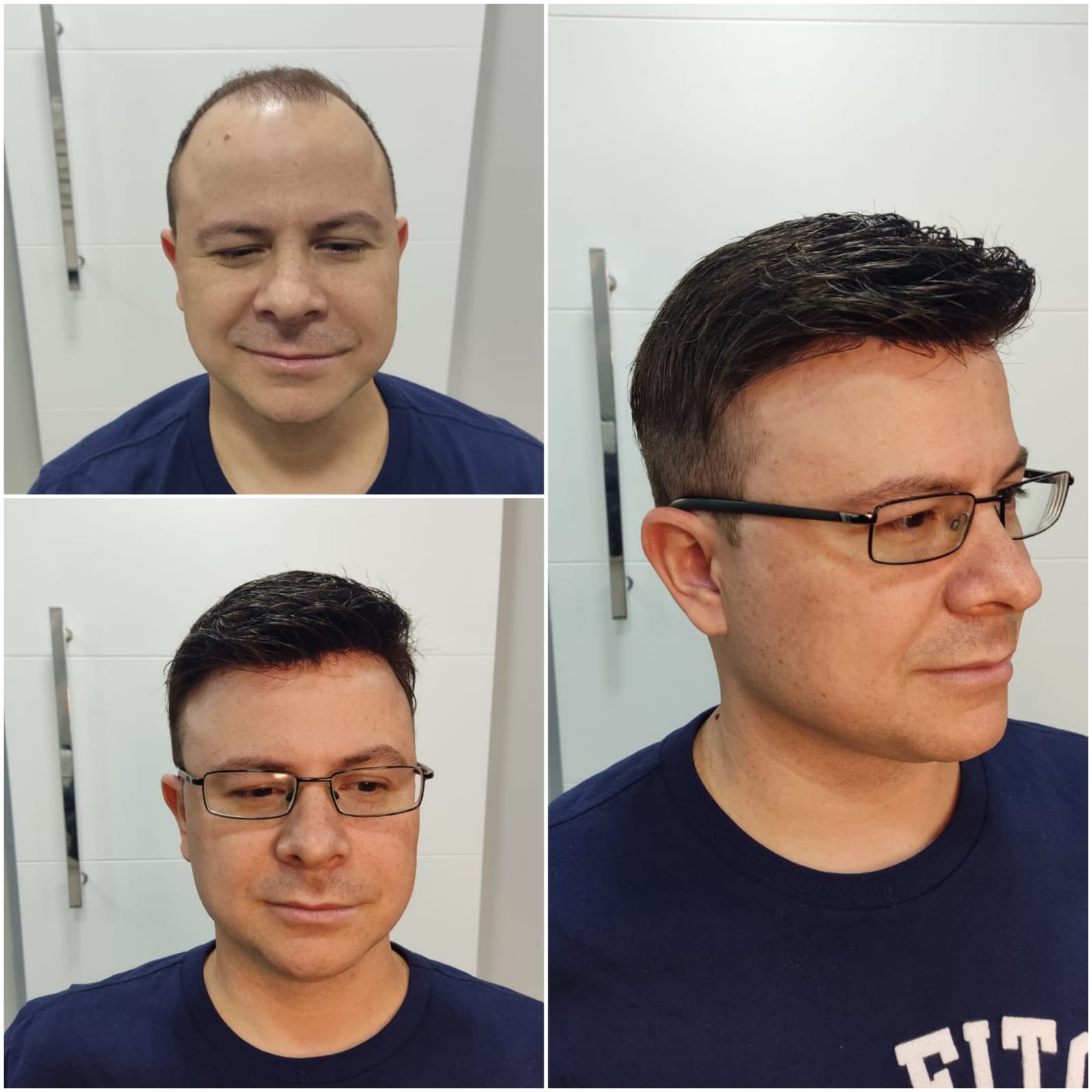 Prótese capilar em Campinas, 100% natural — Capilary Clinic